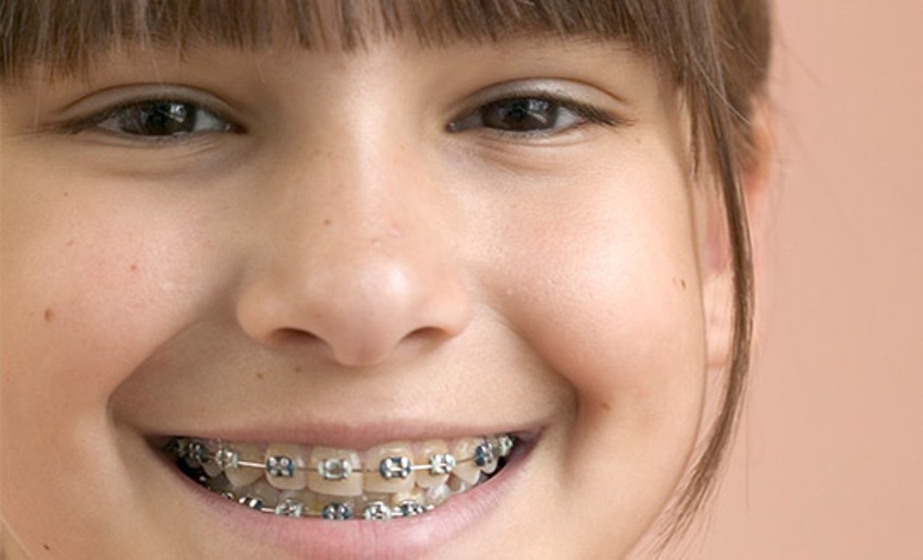 Kieferorthopädie und Laser-OP - lächelndes Mädchen mit Zahnspange